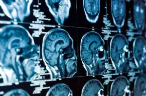 Brain injury scan results